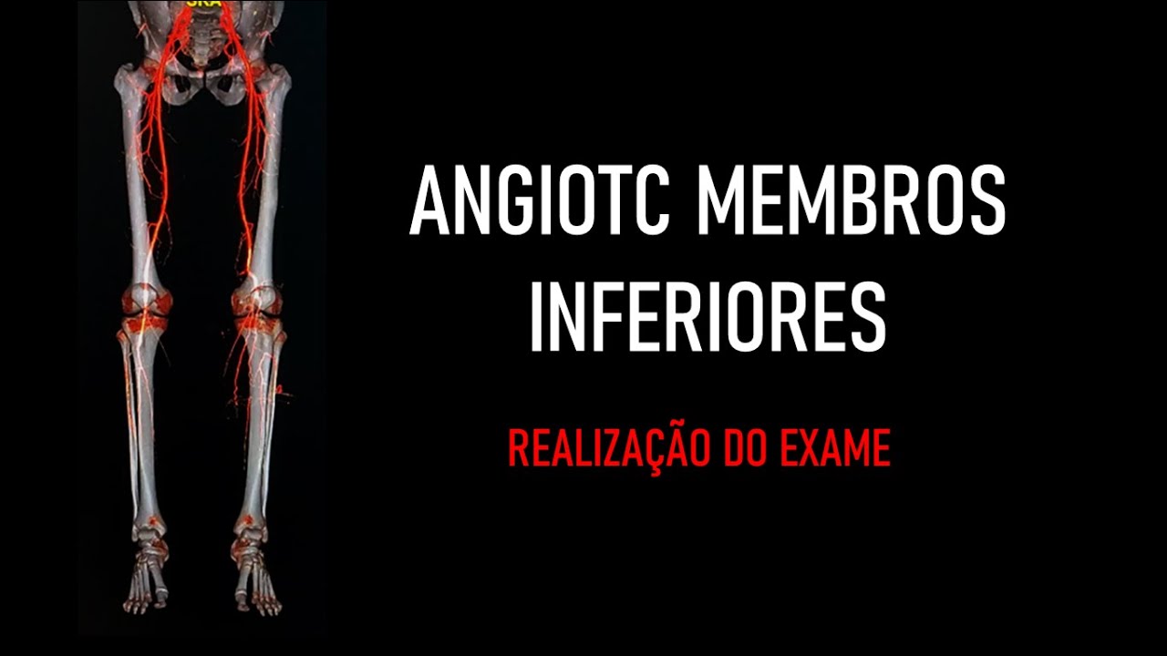 Angiotomografia Membros Inferiores (REALIZAÇÃO DO EXAME)