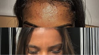 how I cleared my forehead acne in  2 WEEKS