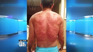 Man Suffers Worst Mosquito Attack Ever