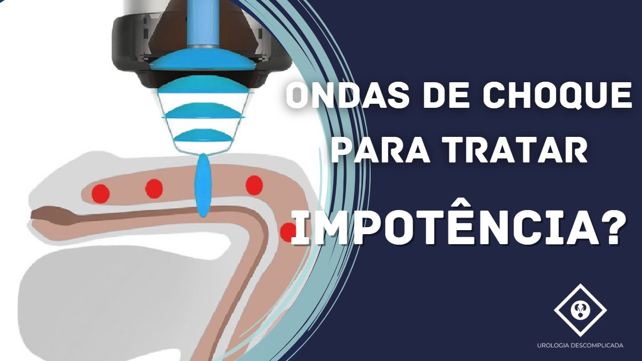 ONDAS DE CHOQUE PARA TRATAR IMPOTÊNCIA FUNCIONA?