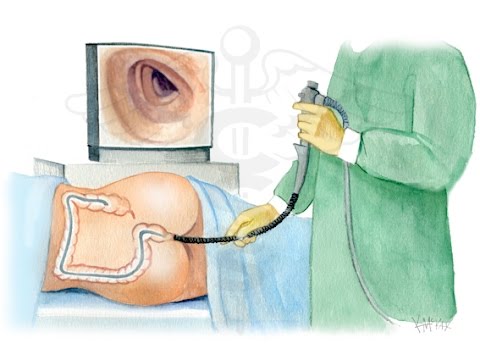 download lagu mp3 mp4 Ohutsuolen Syp, download lagu Ohutsuolen Syp gratis, unduh video klip Ohutsuolen Syp