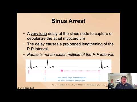 Paramedic Cardiology Module 3-1 Lecture 5: Sinus Pause Block and Arrest