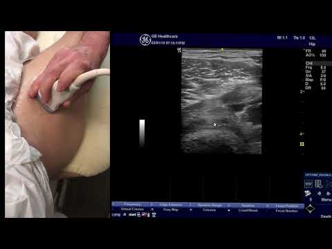 Ultrasound tutorial for the reflected head of rectus femoris