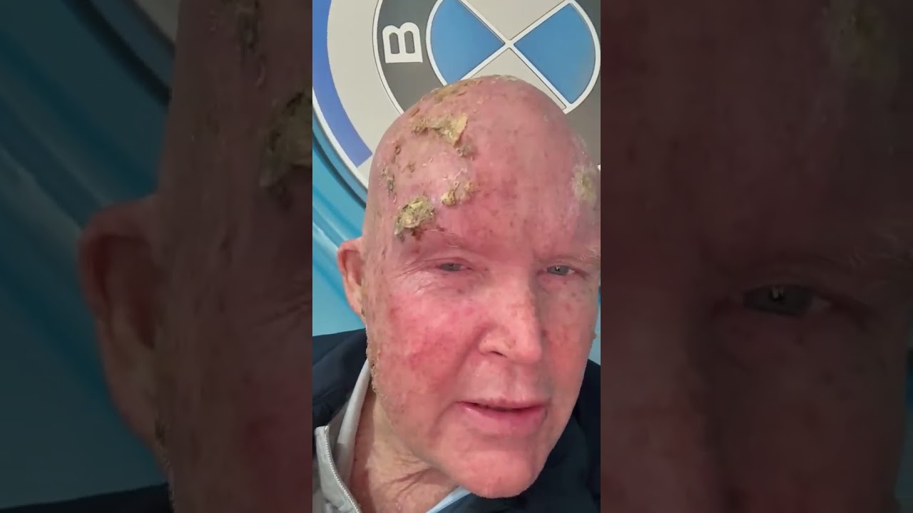 Oscar Chalupsky Health Update 02June 26