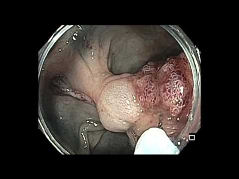 Colonoscopy: Giant Sigmoid Colon Polyp Resection