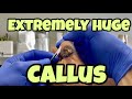 WHAT S UNDERNEATH THIS CALLUS