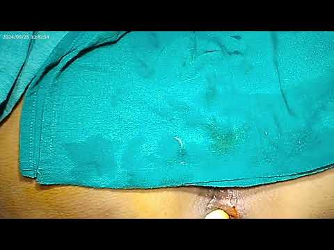 OPB MOLIS with stitch closure operative video