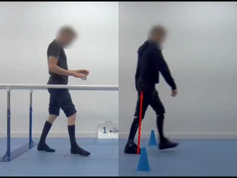 Charcot Marie Tooth patient improves movement with Neuroswing AFOs