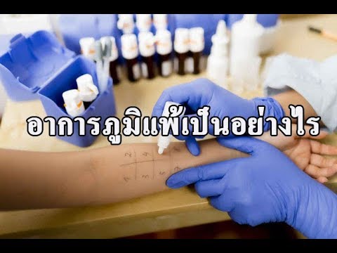 จุดสีแดงของโรคสะเก็ดเงิน ตำรวจและโรคสะเก็ดเงิน