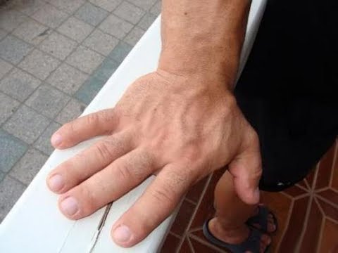 Wie die Gelenke der Finger behandeln ALMAG Quote für den Kniegelenkersatz in St. Petersburg