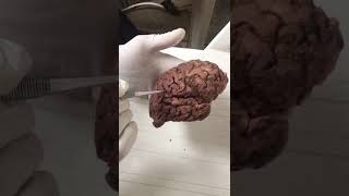 Dr Medhat - lateral surface of the brain