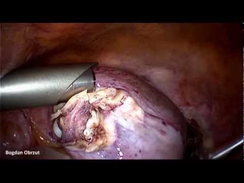 LASH- laparoscopic supracervical hysterectomy