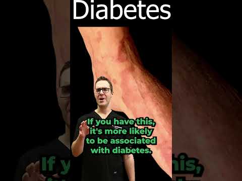 Best Varicose Vein Home Treatments Top 25 Spider Veins Remedies