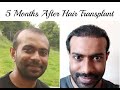 Hair Transplant After 5 Months Review Of PRP