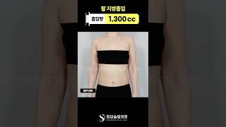 2달 만에 완벽한 직각어깨