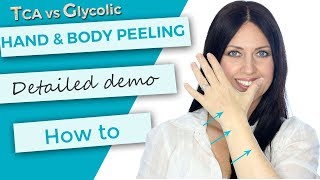 Hand and Body Peeling | Tutorial | Demonstration | TCA 30 versus Glycolic 70