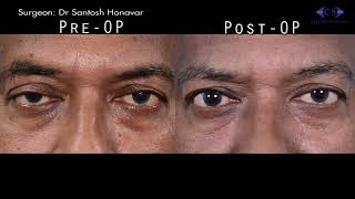Ptosis Correction by Levator Plication