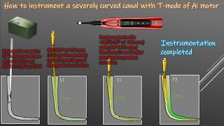 How to use T mode of Ai motor to instrument a severely curved canal/超湾曲根管をAiモーターのTモードで形成する方法