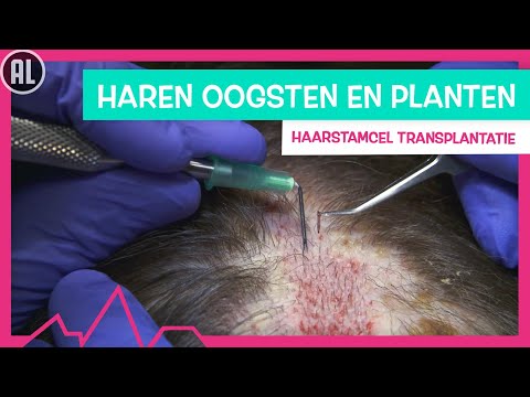 NIEUWE HAREN VOOR ANOUK - TOPDOKS NET FF ANDERS HAARTRANSPLANTATIE
