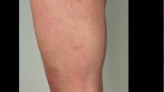 Thread Veins on the Legs - best treatment for removal