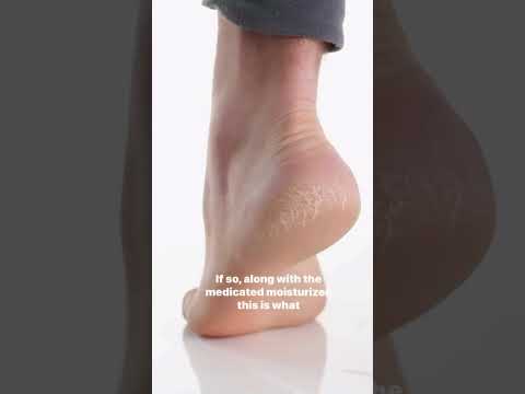 Cracked Heels and Solutions to it's problems #heels #crackedheels #crackedheelsremedy #shorts