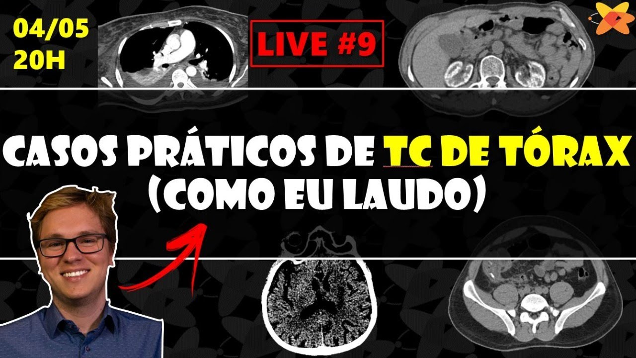 CASOS PRÁTICOS DE TOMOGRAFIA DE TÓRAX | LIVE DE TC #9