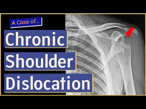 Chronic Shoulder Dislocation