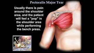 Pectoralis Major Tear - Everything You Need To Know - Dr. Nabil Ebraheim