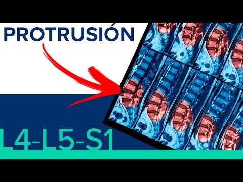 L4-L5 and L5-S1 PROTRUSION 😤 Herniated disc or disc protrusion?