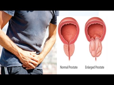 Come ridurre ledema adenoma prostatico Qual è la diffusione della prostata