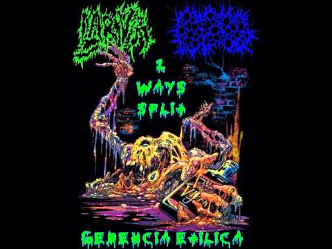 BxPxGx-malformacion adenomatoide quistica congenita