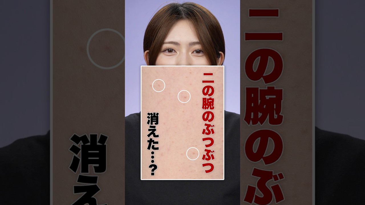 【1ヶ月検証】二の腕のぶつぶつが消える？#二の腕のぶつぶつ #毛孔性苔癬 #毛孔性角化症