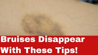 How to Get Rid of Bruises Fast -- Astonishingly Easy Steps!