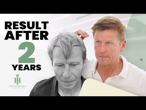 Mark McNally's Remarkable Hair Transformation