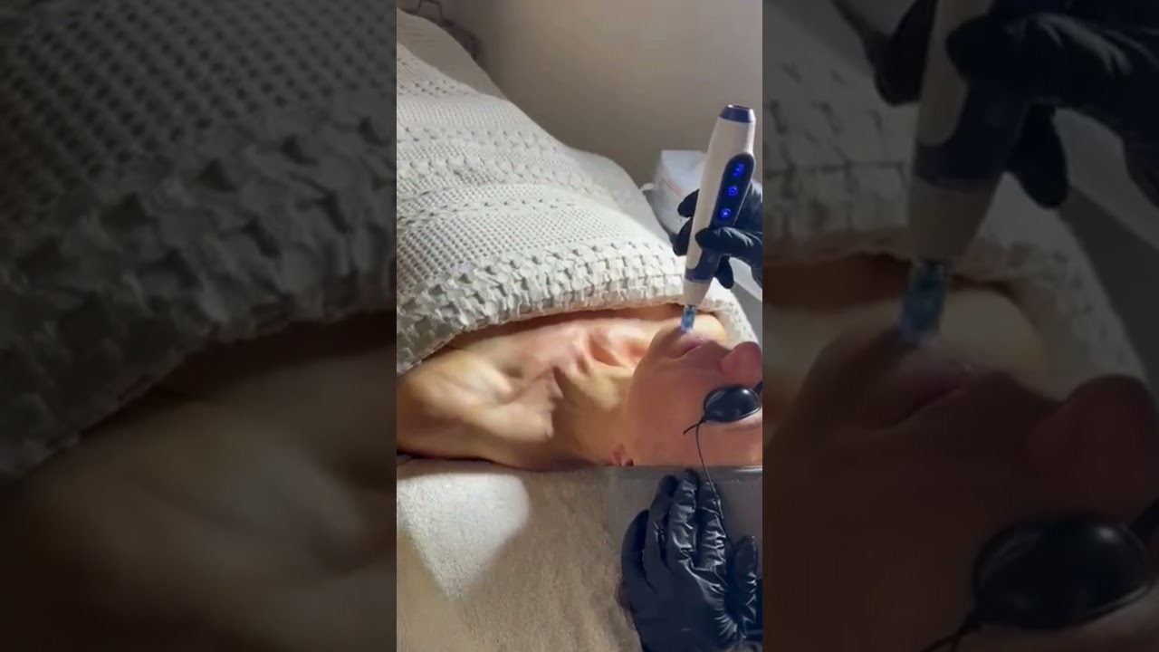 MicroNeedlling Treatment