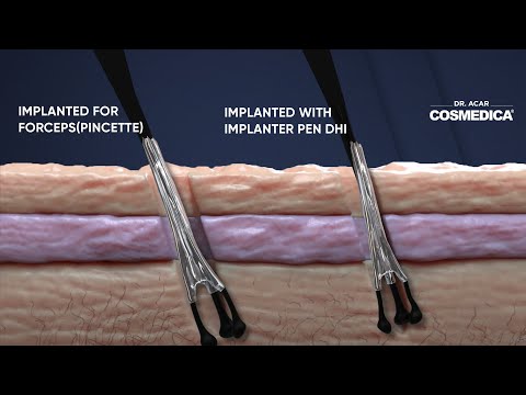 Dhi Micro Sapphire vs Fue Cosmedica Hair Transplant Dr. Acar