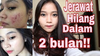 My Acne Story | Jerawat hilang dalam 2 bulan!! [subtitle bahasa]