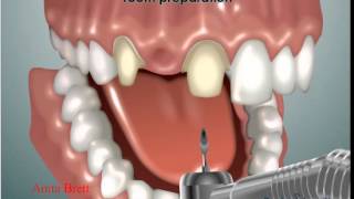 Geçici Kron Ve Porselen Kron Uygulaması