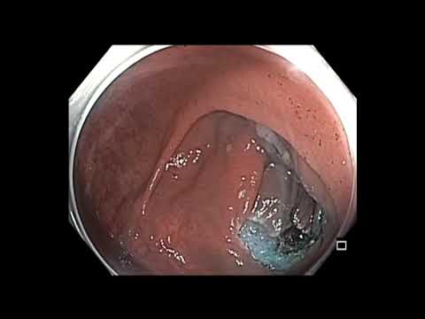 Colonoscopy: Ascending Colon - LST-NG