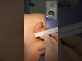 Penile Enlargement Surgery Penis Surgery Dr Araz Bayramov