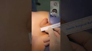 Download lagu Penile enlargement surgery - Penis surgery - Dr . Araz Bayramov mp3 Download lagu Penile enlargement surgery - Penis surgery - Dr . Araz Bayramov mp3