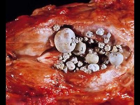 Il sesso nella prostata I sintomi della prostatite Dieta Trattamento