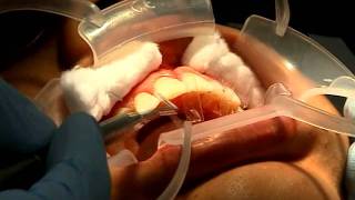 DISEÑO DE SONRISA.mov