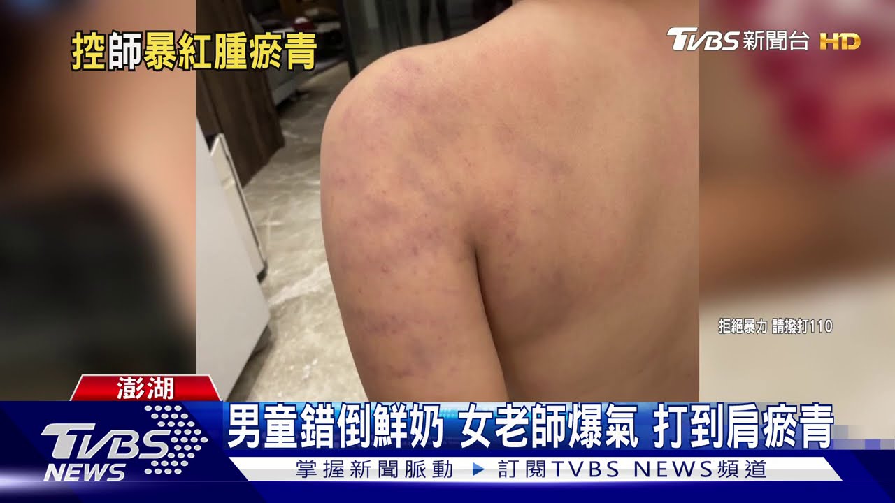 男童錯倒鮮奶　女老師爆氣打到肩瘀青