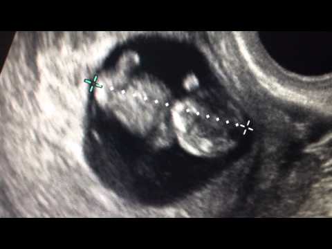 9 weeks ultrasound baby moves!!! (2:19)