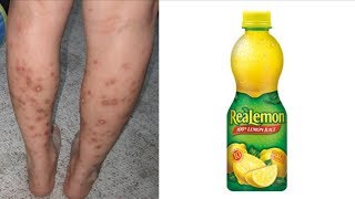 Home Remedies Series || Get Rid of Dark Spots On Legs & Body With Lemon Juice
