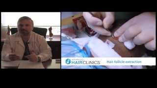 Φαλάκρα:λύση με μεταμόσχευση μαλλιών _O Δρ.Αναστάσιος Βεκρής μας ενημερώνει