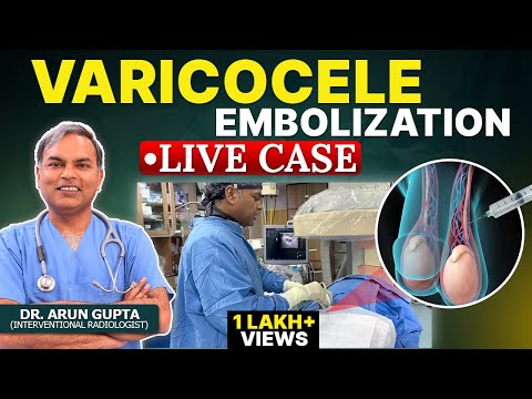 Live Case - Grade 3 Varicocele Embolization | Non-Surgical Treatment of Varicocele | Dr. Arun Gupta