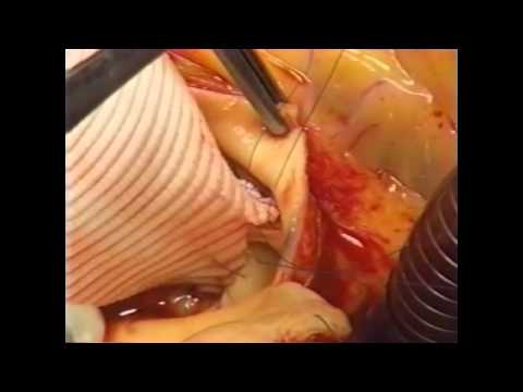 Przebudowa opuszki aorty z powodu dwupłatkowej zastawki aortalnej