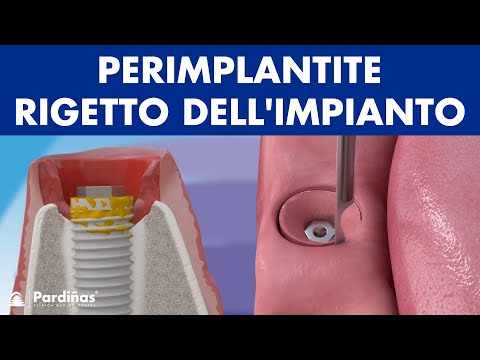 Perimplantite (italiano) ©